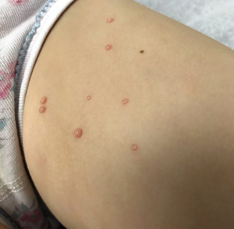 Peau présentant des Molluscum Contagiosum