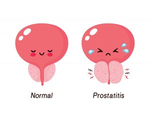 L’hypertrophie bénigne de la prostate